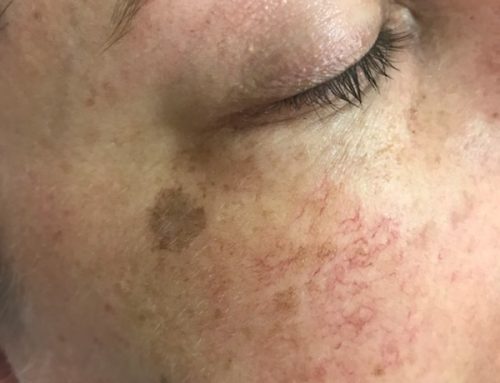 What can IPL pigmentation therapy do for sun damaged skin?